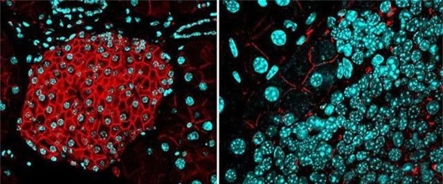 Các nhà khoa học khám phá ra cách ngăn chặn ung thư di căn - 1