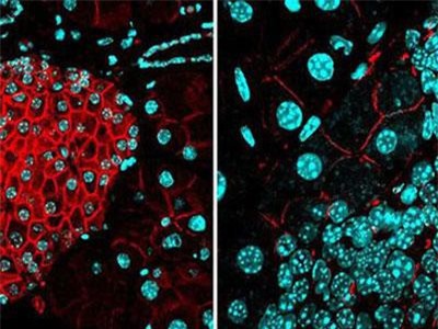 Các nhà khoa học khám phá ra cách ngăn chặn ung thư di căn