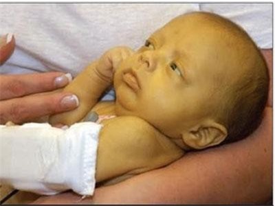 Vàng da ở trẻ sơ sinh và những điều mẹ cần biết