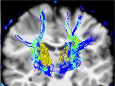 Cảnh giác với bệnh Parkinson nếu mắt có những triệu chứng này