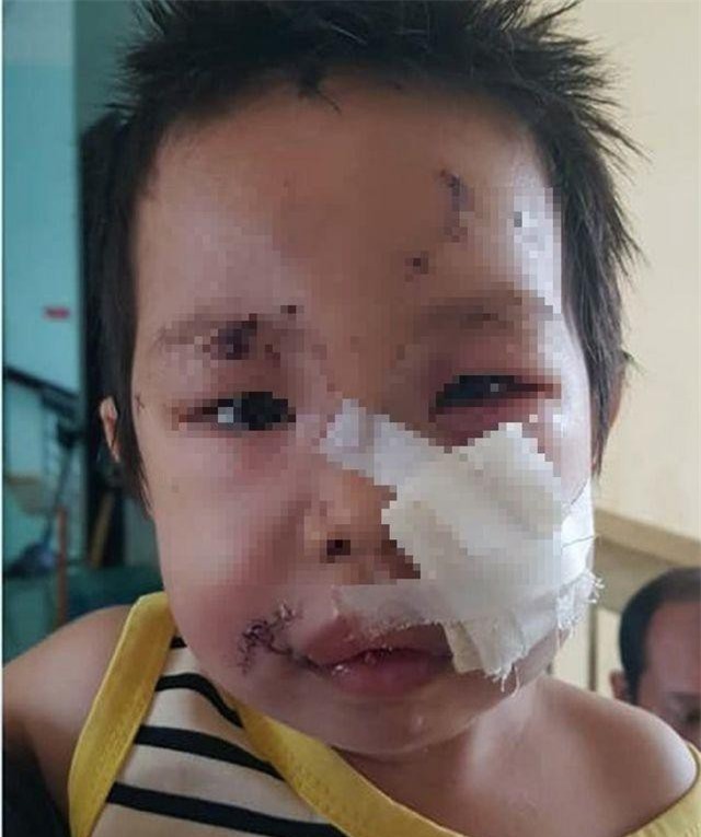 Đắk Nông: Hai chị em bị thương nặng do chó nhà hàng xóm tấn công