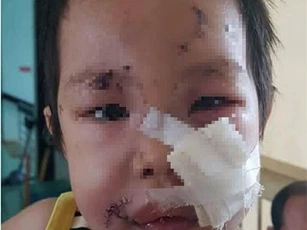 Đắk Nông: Hai chị em bị thương nặng do chó nhà hàng xóm tấn công
