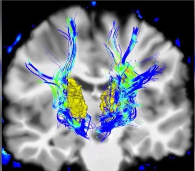 Cảnh giác với bệnh Parkinson nếu mắt có những triệu chứng này - 1