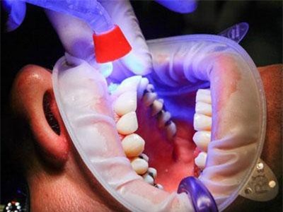 Có nên súc miệng sau khi đánh răng?