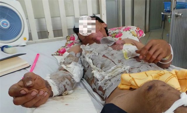  Long An: Máy bơm thuốc bị rò xăng, nam thanh niên thành “đuốc sống”