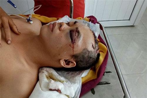 Phú Yên: Truy tìm nghi can chém người, cướp tài sản giữa ban ngày