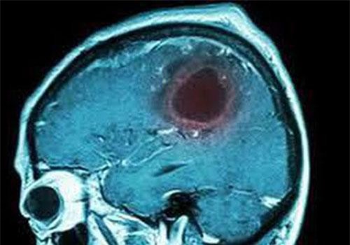 5 triệu chứng u não mà bạn không nên bỏ qua