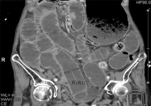Trướng bụng, nôn ói ở người lớn tuổi coi chừng bệnh nguy hiểm