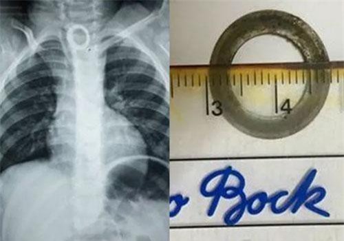 Con trai 2 tuổi ho cả tháng trời, đi khám phát hiện... mảnh kim loại trong thực quản