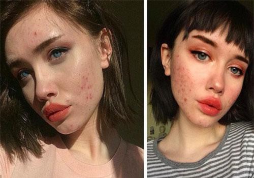 Đây là những nguyên nhân chẳng ngờ đến khiến mụn cứ mọc đi mọc lại ở cùng một vị trí