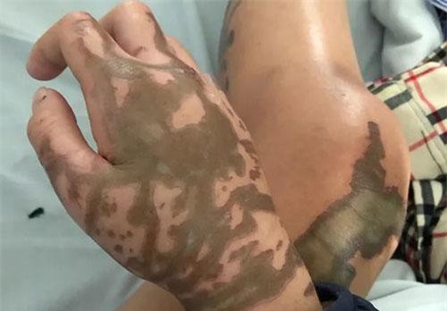 Vụ thiếu uý công an tạt axit vào vợ sắp cưới: Tước quân tịch hung thủ