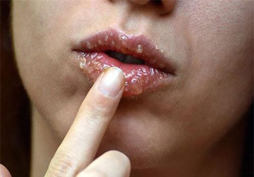 Loại mật ong đặc biệt có thể chữa các vết loét không kém thuốc kháng sinh