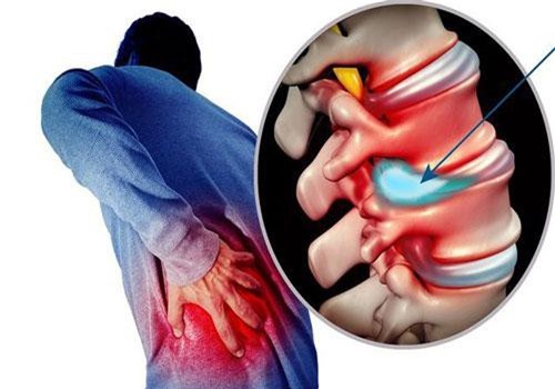Lạm dụng thuốc giảm đau người thoát vị đĩa đệm dễ tàn phế