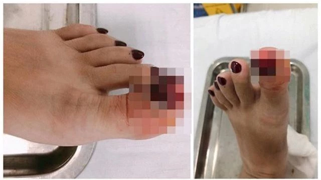 MC Hoàng Linh bị tai nạn lật ngón chân, phải nhập viện - 2