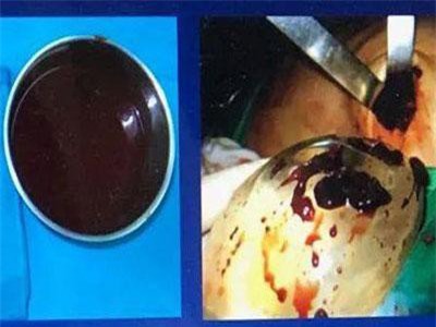 Bác sĩ lấy gần 500g máu cục trong ngực nữ doanh nhân bị biến chứng thẩm mỹ