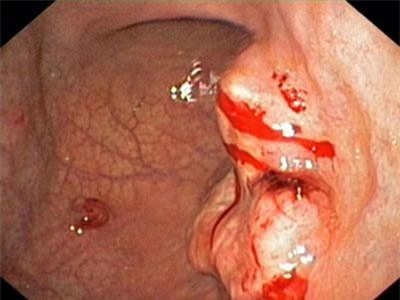 70% dân số Việt Nam có nguy cơ mắc bệnh lý dạ dày