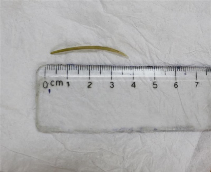 Quảng Ninh: Nuốt xương cá dài 4cm khi ăn lẩu gây thủng ruột non