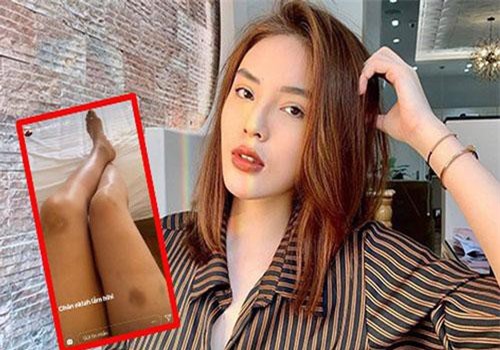 Hoa hậu Kỳ Duyên đăng ảnh đôi chân bầm tím, đen sạm sau khi trở về từ “Cuộc đua kỳ thú”