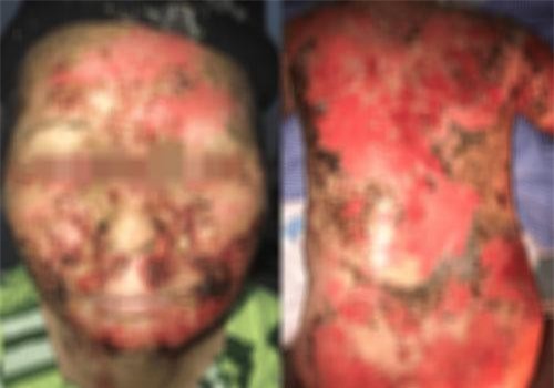 Da bong trợt, rỉ dịch, bốc mùi hôi thối do tắm lá, dùng thảo dược trị bệnh