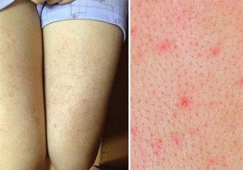 Cẩn thận với những căn bệnh về da thường gặp trong mùa hè, đặc biệt là bệnh số 3
