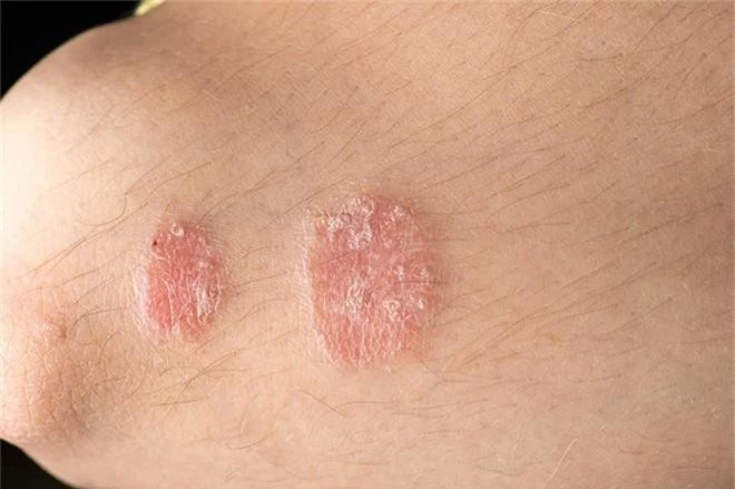 Cẩn thận với những căn bệnh về da thường gặp trong mùa hè, đặc biệt là bệnh số 3 - Ảnh 1.
