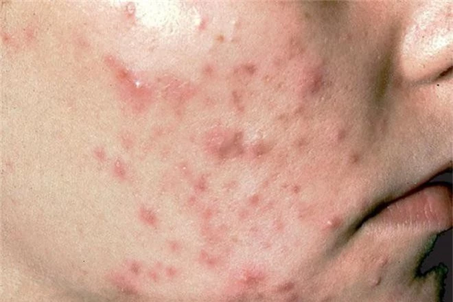 Cẩn thận với những căn bệnh về da thường gặp trong mùa hè, đặc biệt là bệnh số 3 - Ảnh 2.