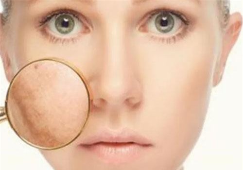 Rám má: Triệu chứng và nguyên nhân chị em nên biết