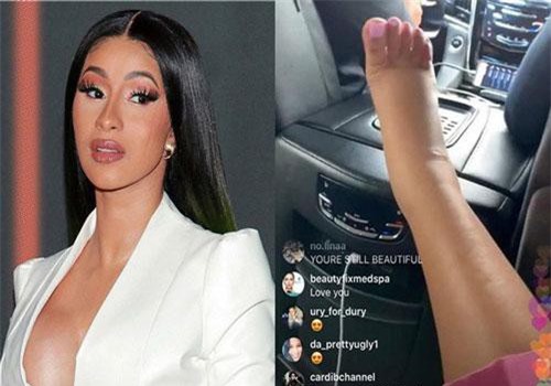 Sưng phồng chân vì nghiện "dao kéo", Cardi B bị chẩn đoán rơi vào tình trạng báo động và nguy hiểm đến tính mạng