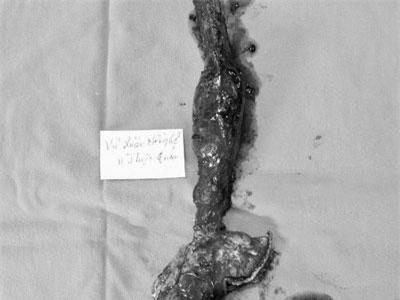 Thái Bình: Nuốt nghẹn, người đàn ông mắc loại ung thư hiếm trên thế giới chỉ 300 người mắc