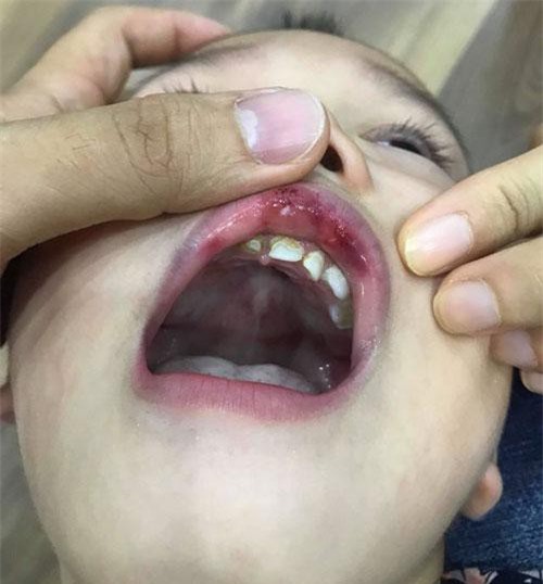 Hà Nội: Cô giáo “vuốt má" bé 3 tuổi hằn cả bàn tay và tụ máu môi