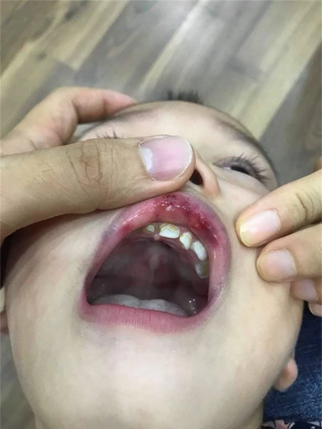 Hà Nội: Cô giáo “vuốt” má bé 3 tuổi hằn cả bàn tay và tụ máu môi - 2