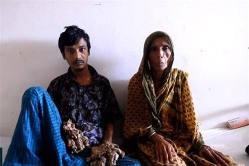 "Người cây" Bangladesh muốn cắt cụt tay chân