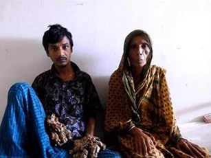 "Người cây" Bangladesh muốn cắt cụt tay chân