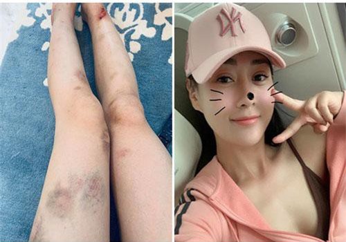 Phương Oanh khoe ảnh đôi chân bầm dập, chằng chịt vết thương sau khi tham gia show thực tế