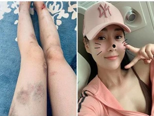 Phương Oanh khoe ảnh đôi chân bầm dập, chằng chịt vết thương sau khi tham gia show thực tế