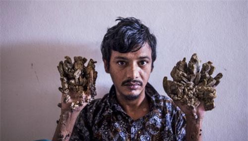 Người đàn ông có "bàn tay của quỷ" muốn chặt bỏ hai bàn tay