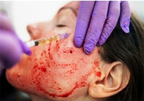 Coi chừng mắc bệnh trọng từ lăn kim máu để trẻ hóa da