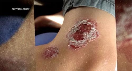 Người đàn ông bị nhiễm vi khuẩn ăn thịt mà không cần chạm vào nước