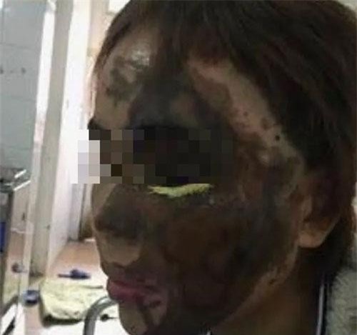 Đà Nẵng: Cựu Thiếu úy công an tạt axit vào vợ sắp cưới chuẩn bị hầu tòa