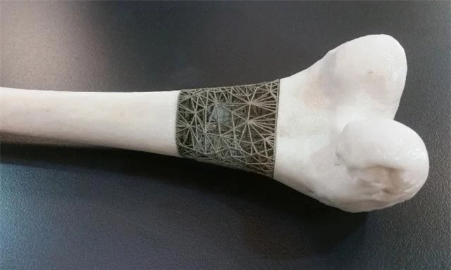Một mẫu cấy ghép xương in 3D