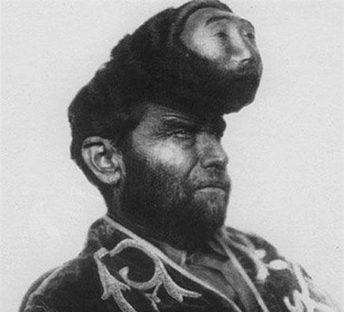 Những người bị dị tật bẩm sinh khác thường nhất trên thế giới