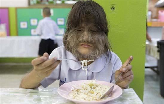 Kỳ lạ: Bé gái mắc hội chứng “người sói”