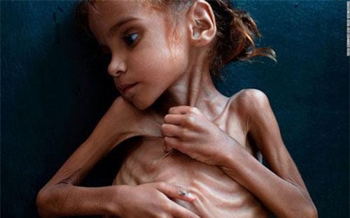 Bé gái da bọc xương gây chấn động về nạn đói ở Yemen qua đời