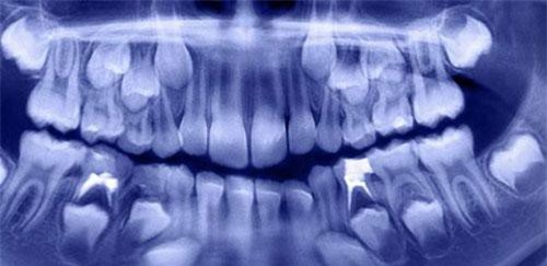 Các nha sĩ lấy ra hơn 500 chiếc răng từ miệng của một cậu bé 7 tuổi