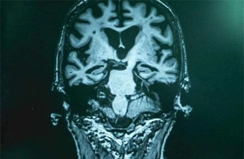 Các nhà khoa học vừa tìm ra cách phát hiện bệnh Alzheimer ở giai đoạn đầu với độ chính xác rất cao.