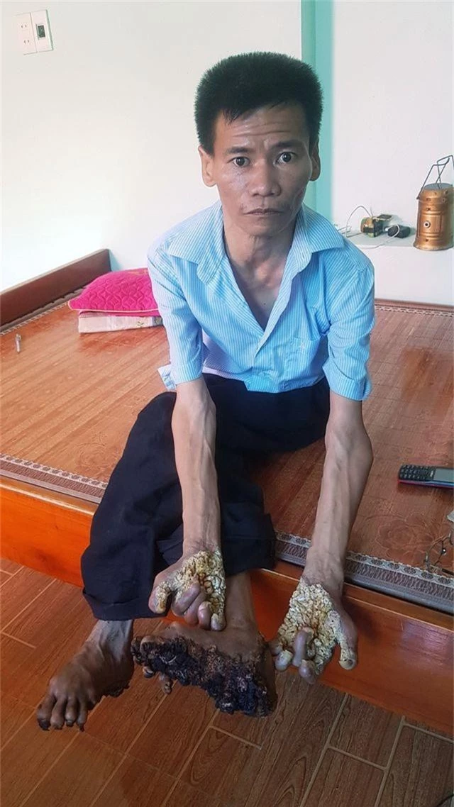 Gặp người đầu tiên mắc căn bệnh kỳ lạ “người cây” ở Việt Nam - 2