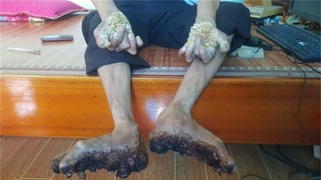 Gặp người đầu tiên mắc căn bệnh kỳ lạ “người cây” ở Việt Nam - 3