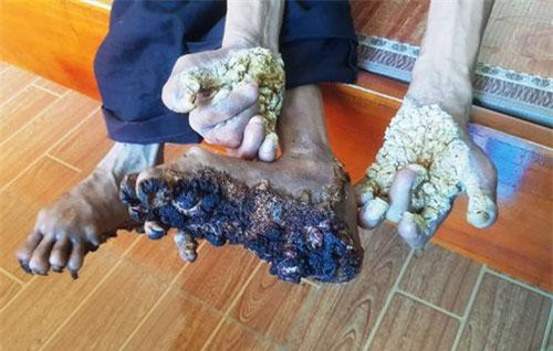 Gặp người đầu tiên mắc căn bệnh kỳ lạ “người cây” ở Việt Nam