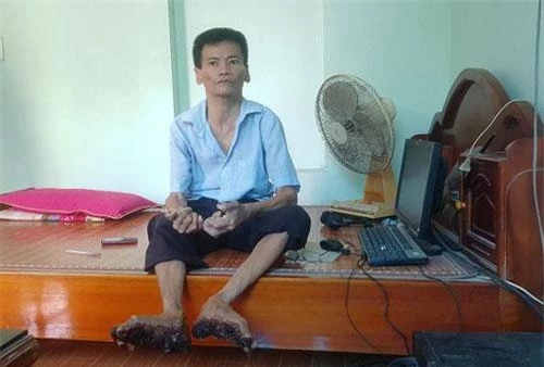 Anh Nguyễn Văn Sơn (SN 1971), ở xóm Tân Sơn, xã Gia Thủy, huyện Nho Quan, tỉnh Ninh Bình mắc phải căn bệnh kỳ lạ từ khi còn nhỏ. Đến nay, anh được chẩn đoán mang trong mình căn bệnh 