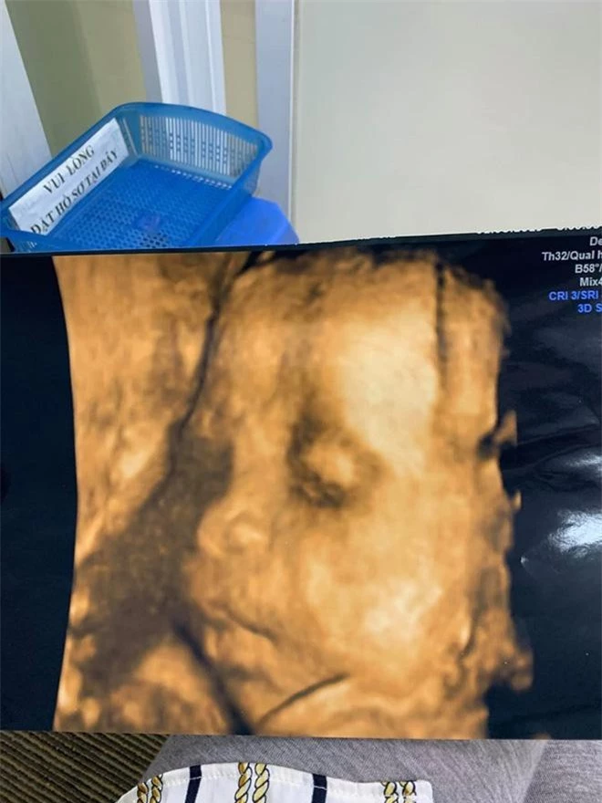 Hình ảnh siêu âm của con gái Ưng Hoàng Phúc - Kim Cương khi tròn 7 tháng tuổi.
